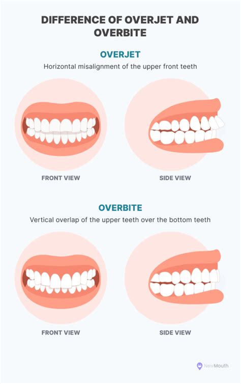 5 Common Overbite Treatment Options - NewMouth