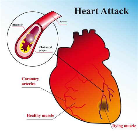 Chest Pain and Heart Attack - Here Is What You Do - Dr Vivek Baliga ...