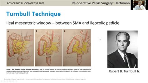 Closing Colostomy in Re Operative Pelvis in Patients Who Have Had a Hartmann's Procedure - YouTube