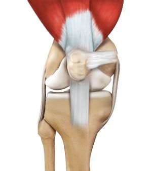 Medial Patellofemoral Ligament Tear Moreno Valley, CA | MPFL Reconstruction Riverside, Corona, CA