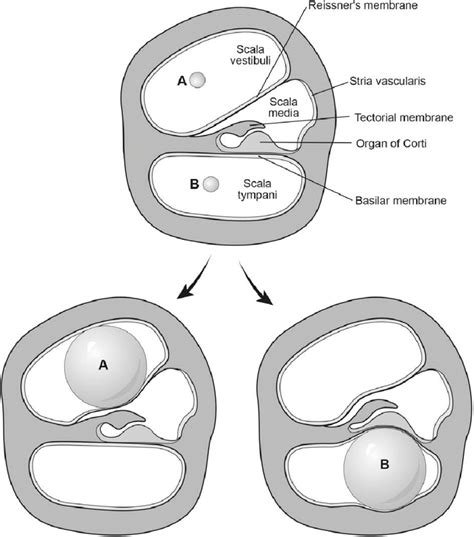 Air bubbles enter the scala vestibuli (A), following a rupture of the... | Download Scientific ...