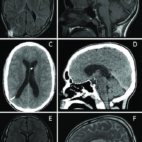 (PDF) Shunt freedom in slit ventricle syndrome: using paradoxical ventriculomegaly following ...