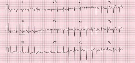 Mitral Valve Stenosis Ecg