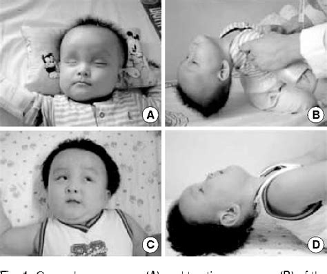 Figure 2 from A Case of Infantile Alexander Disease Accompanied by Infantile Spasms Diagnosed by ...