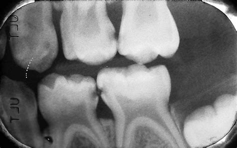 Tooth Cavity Xray