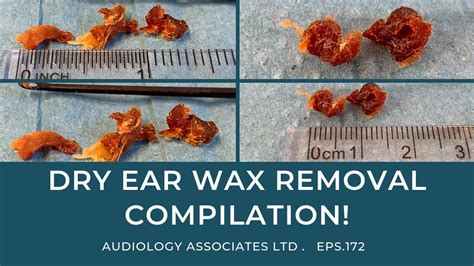 DRY EAR WAX REMOVAL COMPILATION - EP 172