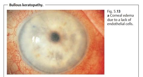 Bullous Keratopathy