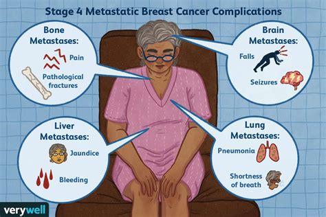 Complications of Advanced (Metastatic) Breast Cancer