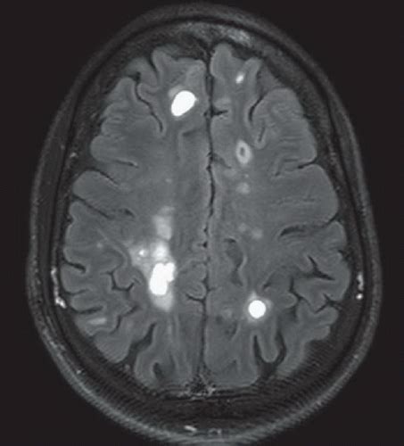 Acute Multiple Sclerosis Flare | Radiology Key