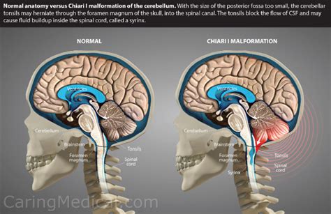 Cerebellar tonsillar ectopia herniation and Chiari 1 malformation: Non-surgical alternatives to ...