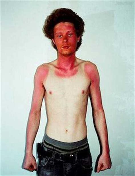 21 Insane Sunburns That Will Make You Fear the Sun - Ouch Gallery Bad Sunburn, Sunburn Art ...