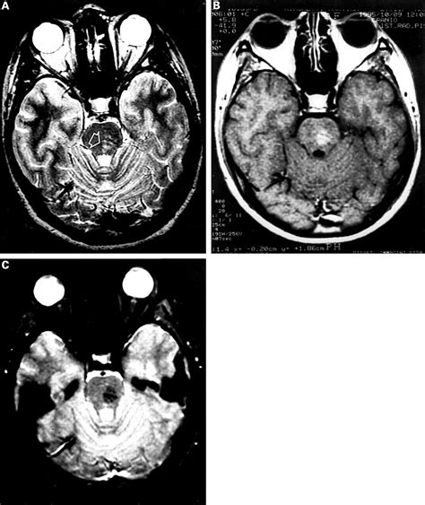 Symptomatic unruptured capillary telangiectasia of the brain stem: report of three cases and ...