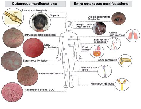 Netherton Syndrome – Medicaregate