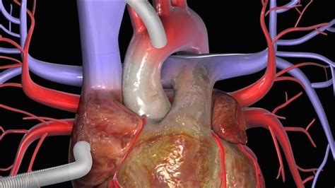 💊 Cirurgia de bypass cardíaco: procedimento, recuperação e riscos - 2021