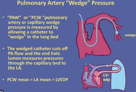 Pulmonary Artery Occlusion Pressure