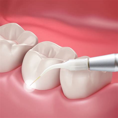 Periodontal Therapy – Wichita, KS – West Wichita, KS