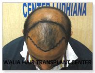 Tim McGraw Hair Transplant - Walia Hair Transplant