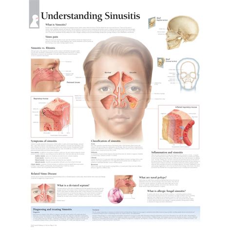 Sinusitis, Sinus infection, Back pain remedies