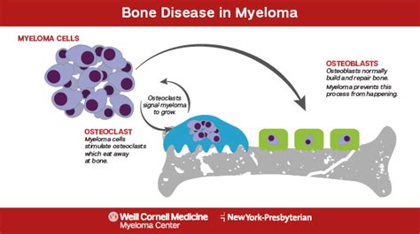 Myeloma Signs and Symptoms | Myeloma Center