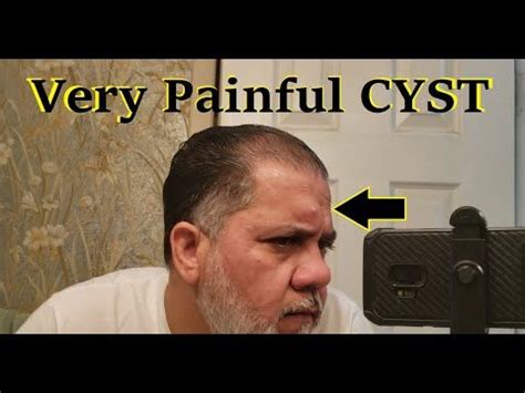 Very Painful Cyst Popping 😧😬🤕 - YouTube Popping Pimples Videos Youtube ...