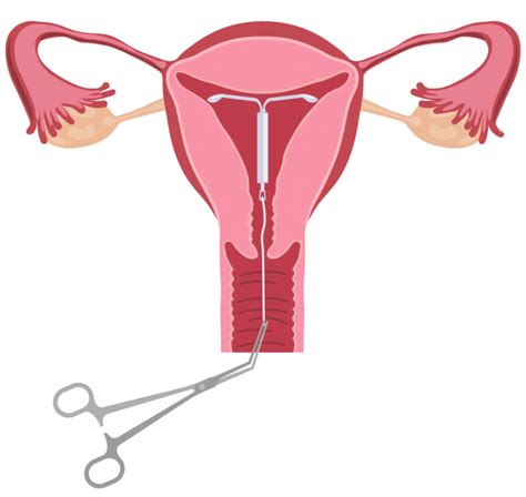 Mirena IUD Removal | Removal Side Effects & What to Expect