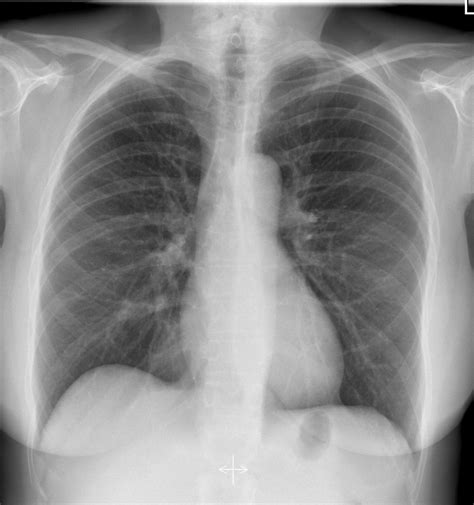 Normal Chest X Ray Images