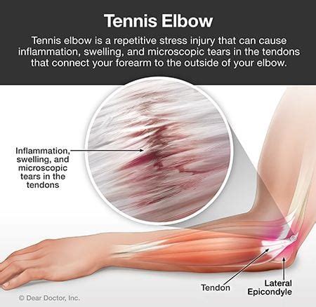 Tennis Elbow | Chiropractor in Liberty, NY | Spina Chiropractic Office