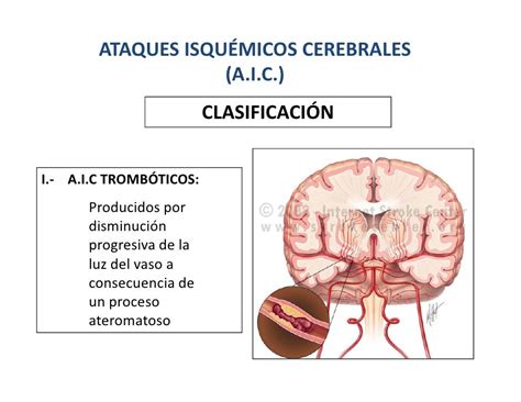 Sintomas De Isquemia Cerebral Transitoria - SEONegativo.com