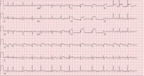 Subtle ECG Findings in ACS: Part I Left Main Coronary Artery Disease - emdocs