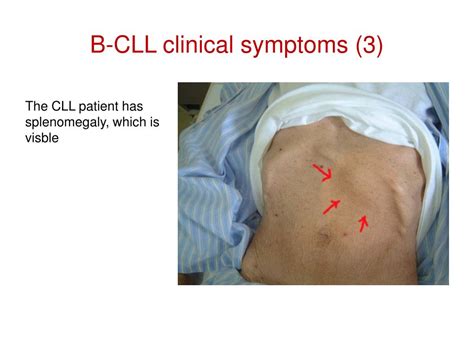 PPT - The Chronic Lymphocytic Leukemia (CLL) PowerPoint Presentation, free download - ID:3275647