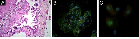 Pemphigus vulgaris associated with nasoseptal perforation, ocular ...