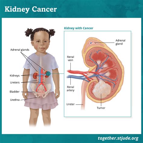 Kidney Tumors in Children and Teens - Together by St. Jude™