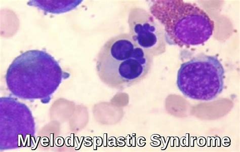 Myelodysplastic Syndrome - Causes, Symptoms, Prognosis & Treatment