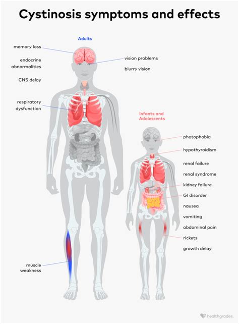 Cystinosis: Symptoms, Causes, and Treatment