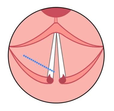 Vocal Cord Cordotomy: Pre-Procedure, Technique, Post-Procedure