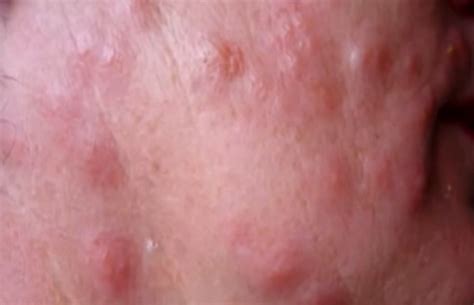 Bed Bug Bites – Pictures, Symptoms, Causes, Treatment | HubPages