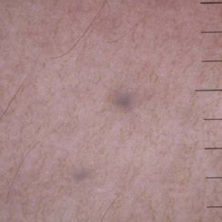 (PDF) Dermoscopic Findings in Eruptive Vellus Hair Cysts: A Case Report