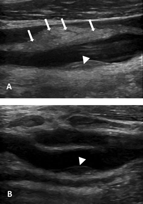 A. B-mode ultrasound scan in the long axis of the left carotid bulb:... | Download Scientific ...