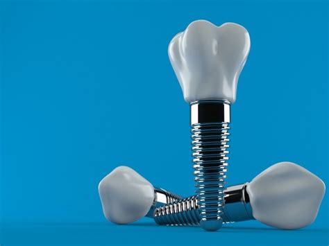 How to Care for Your Dental Implant