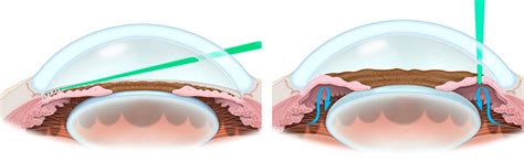 Peripheral Iridotomy Laser - South Bay Retina