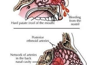 Epistaxis Basics : Anatomy, Physiology and Pathology | Epomedicine