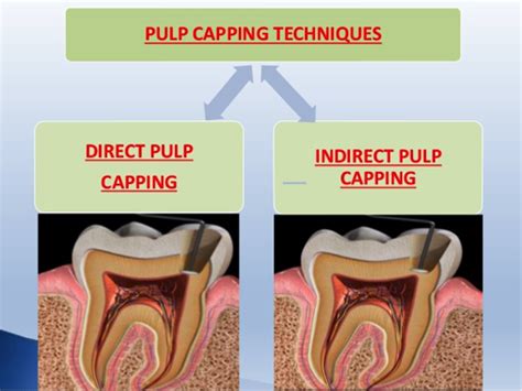 Dental Pulp Capping | Holistic Dentistry - Dr. Jeff Etess