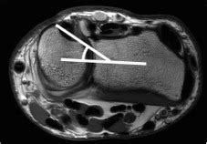 References in ECU tendon subluxation: A nonspecific MRI finding occurring in all wrist positions ...