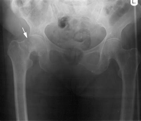 Osteoporosis (Suspected)