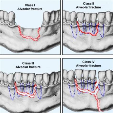 Alveolar Fracture | News | Dentagama