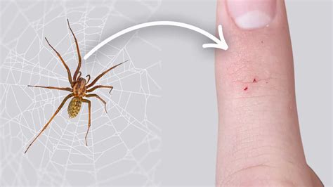 15 Types Of Spider Bites: Identification Chart with Picture