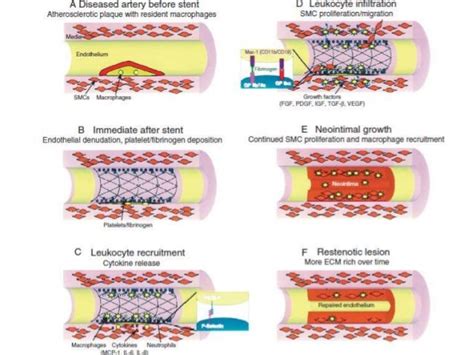 IN STENT RESTENOSIS