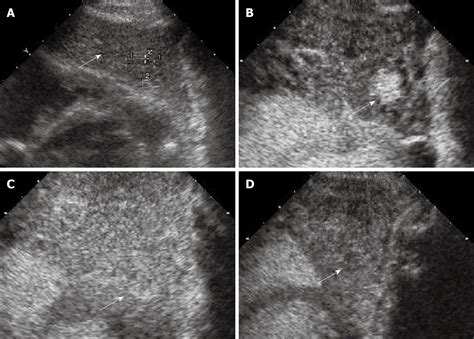 Cirrhosis Ultrasound