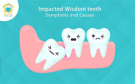 Impacted Wisdom teeth -Symptoms and Causes - Elite Dental Care