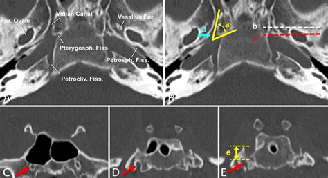 A and B: Fine-slice CT scans. "a" = the angle between the pterygoid... | Download Scientific Diagram